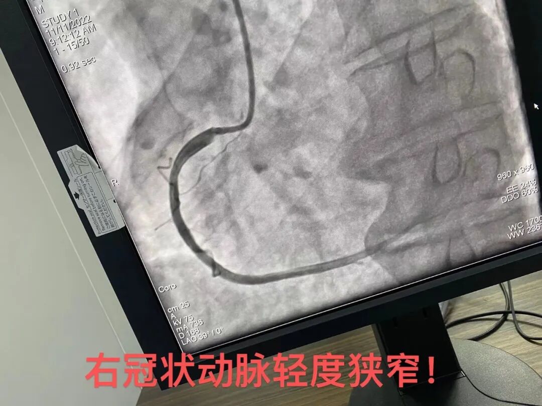 dsa是什么设备沭阳百姓的健康福音——国际高端设备西门子数字减影血管造影机（DSA）你了解多少？_https://www.jmylbn.com_新闻资讯_第15张