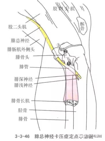 坐骨神经之腓总神经卡压综合症
