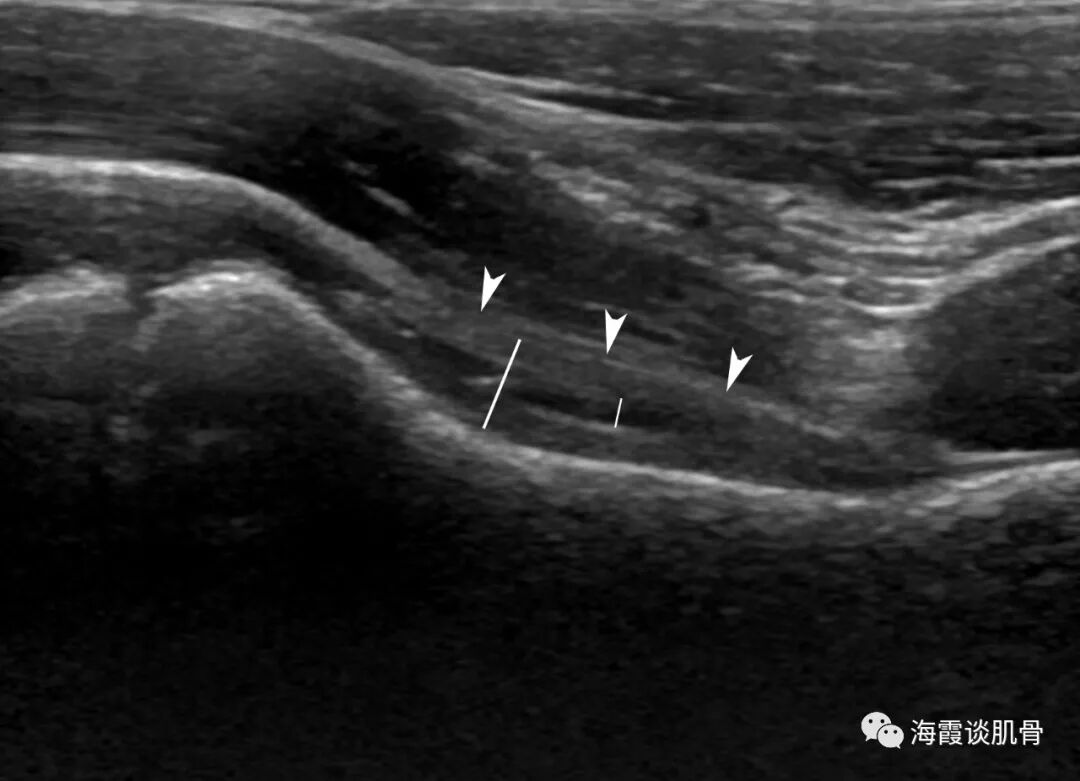 诡异的小儿髋关节一过性滑膜炎