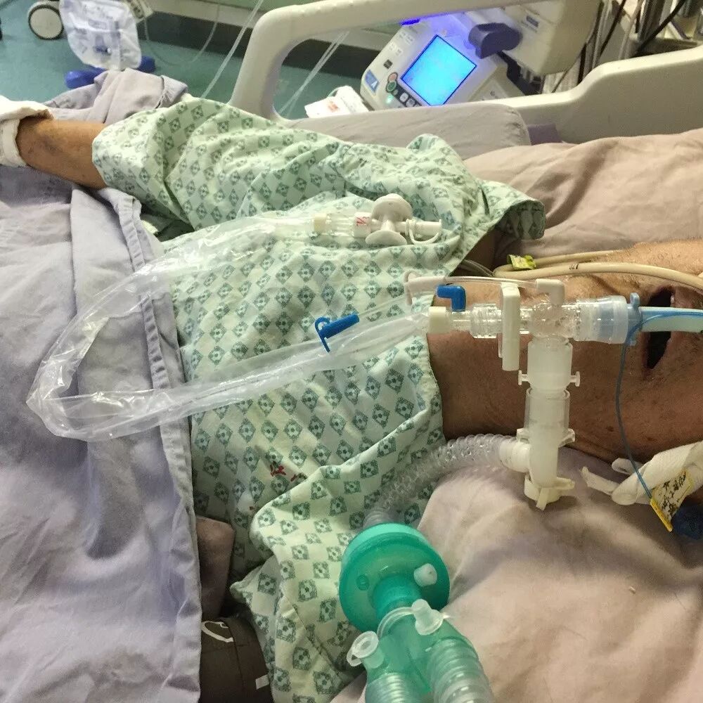 为什么使用密闭式吸痰管密闭式吸痰技术三两事_https://www.jmylbn.com_新闻资讯_第4张