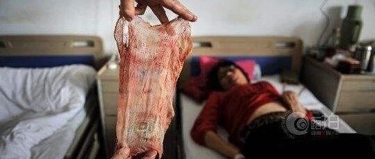 又发生！女子产后2周取出纱布，已恶臭、发黑……