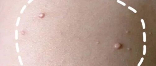 手上、脸上的疣哪些是HPV导致的？6种常见疣的区分和治疗