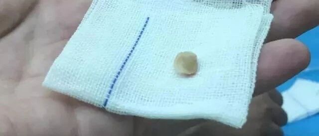 半粒花生米，一张病危通知书！请把医生4000字忠告转给更多父母