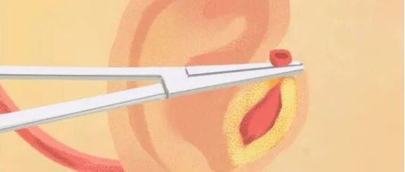 1%的人耳朵上有这个「神秘」小孔……