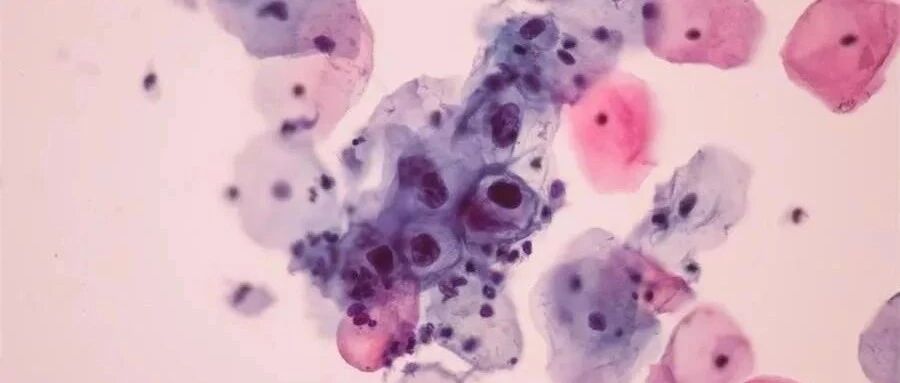 《柳叶刀》：二价HPV疫苗可提供长效保护！接种后也要做好这一点