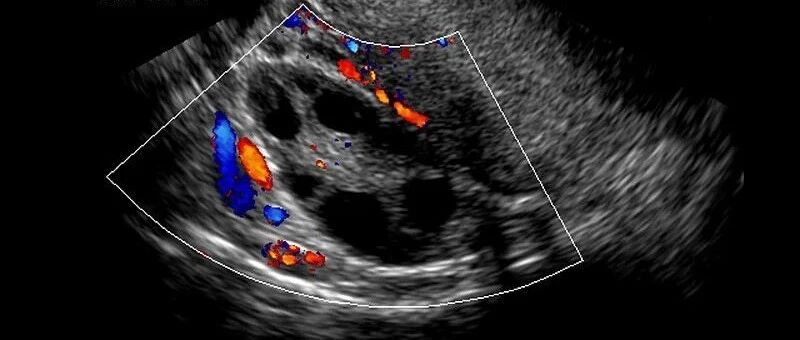 骨灰级整理 详细解读的妇产科各种超声指标