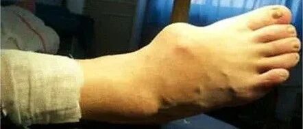 痛风有多痛？53岁男子被活活疼死！这些食物一定要忌口