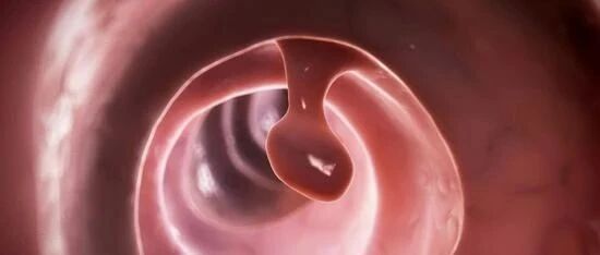 我叫息肉，是癌的近亲！一封来自息肉的认罪书