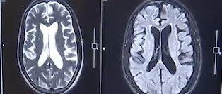 没有性生活,38岁男子因梅毒导致“痴呆晚期”，医生：这些行为要小心！！