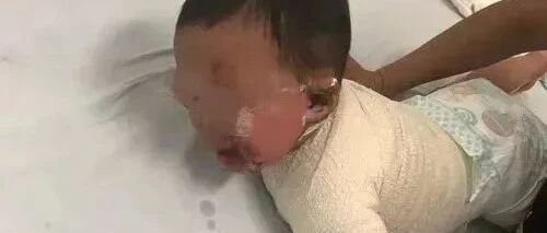 男婴被100℃洗澡水烫伤！妈妈不顾全家反对做了一件事，医生也点赞！