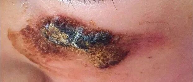 把芦荟胶当万能胶！无知"毁"了多少女人和孩子！