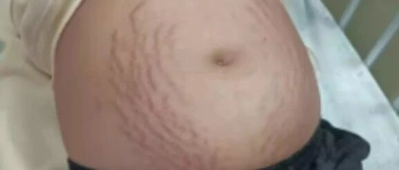 13岁女孩肚大如怀孕，腹中藏了个巨大的卵巢囊肿！