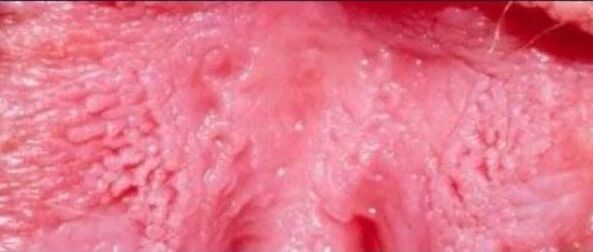 下面长了一圈肉疙瘩，都是“啪啪啪”惹的祸？