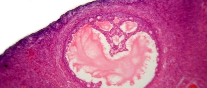 这个癌症几乎没有症状，20-30%和遗传有关