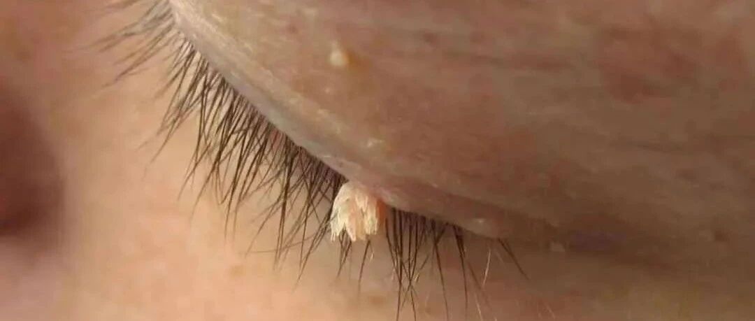 身上长了“鱿鱼丝”，竟是HPV感染！