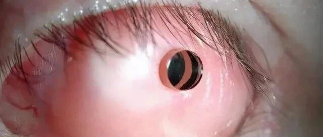 全身烧伤，眼睛几乎被烧熟！这家医院用一颗「牙齿」让他重获光明