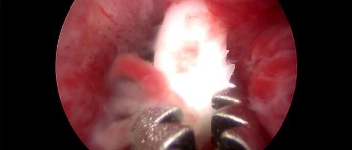 “妈，是时候去取环啦！”