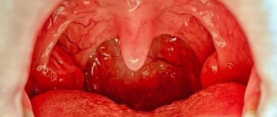奥斯卡影帝因“口交”患喉癌，7成喉癌与HPV有关！