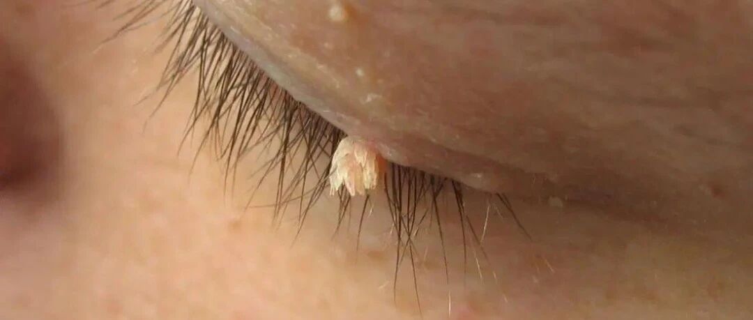 身上长了“鱿鱼丝”，竟是HPV感染！