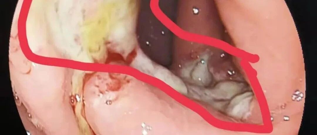 4岁小孩反复口腔溃疡1年无法吃饭，原来是这个病