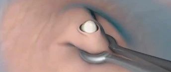 3D演示-男性结扎手术过程