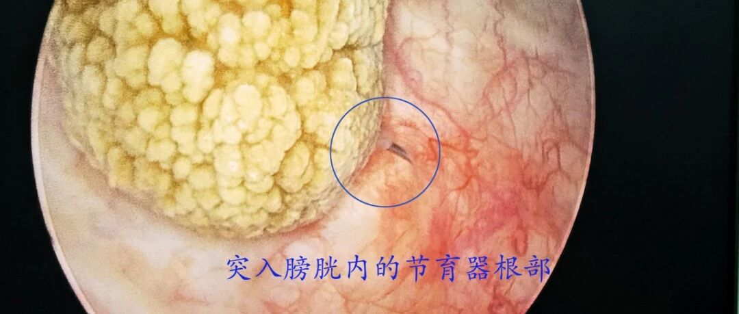 又见节育环穿透子宫刺入膀胱，有这几个症状，没绝经也要去取环