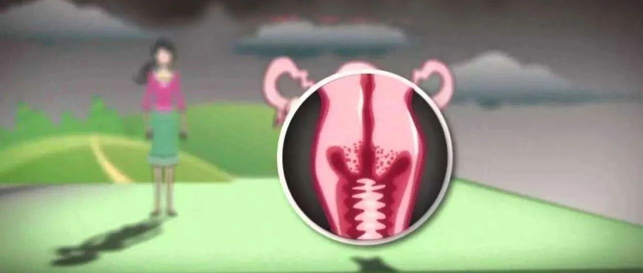 2020年HPV疫苗接种ACOG专家委员会意见【NO.809（取代2017年6月原704号）】