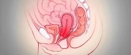 宫颈癌的早期信号，你注意了吗?