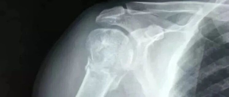 医生被打成粉碎性骨折 检察院却建议“从轻处理”？中国医师协会：严惩伤医犯罪分子！