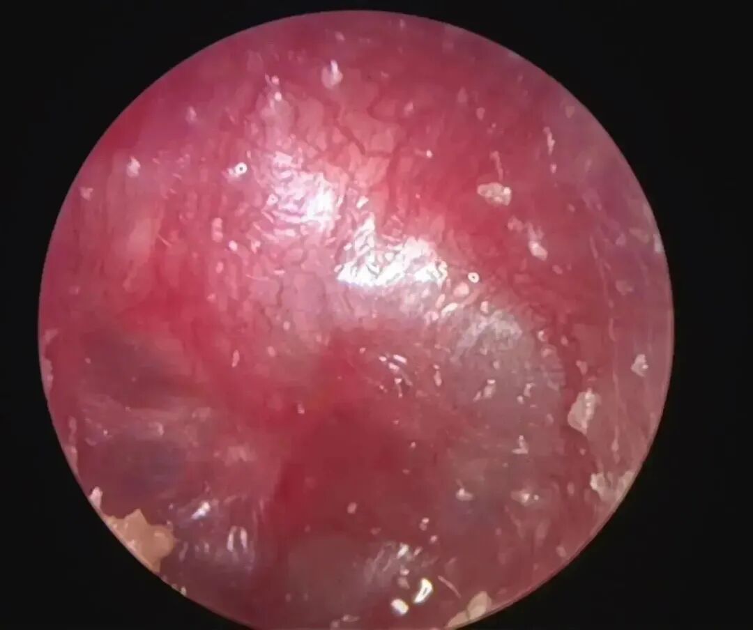 耳朵内窥镜什么样【红旗科普】一文读懂 ｜ 耳内窥镜可以做哪些检查？_https://www.jmylbn.com_新闻资讯_第17张