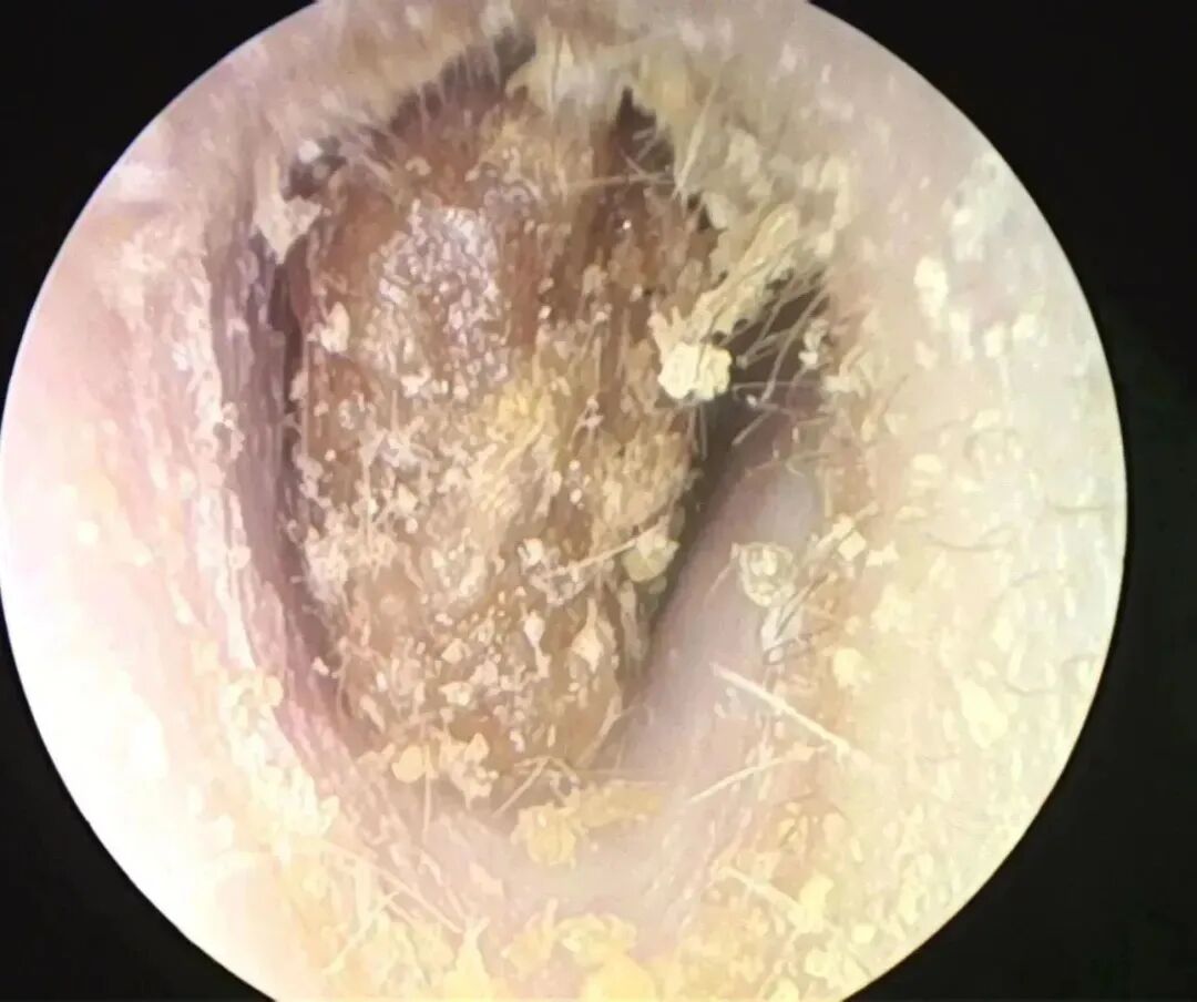 耳朵内窥镜什么样【红旗科普】一文读懂 ｜ 耳内窥镜可以做哪些检查？_https://www.jmylbn.com_新闻资讯_第15张