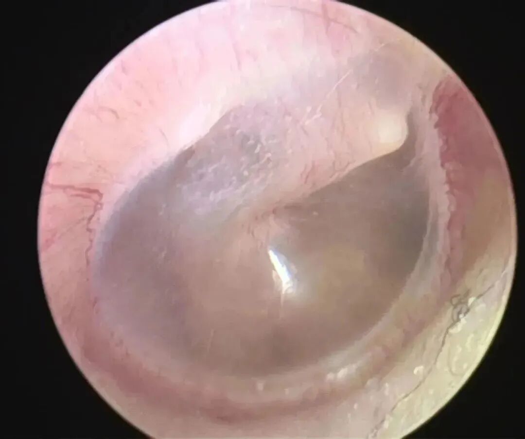 耳朵内窥镜什么样【红旗科普】一文读懂 ｜ 耳内窥镜可以做哪些检查？_https://www.jmylbn.com_新闻资讯_第11张