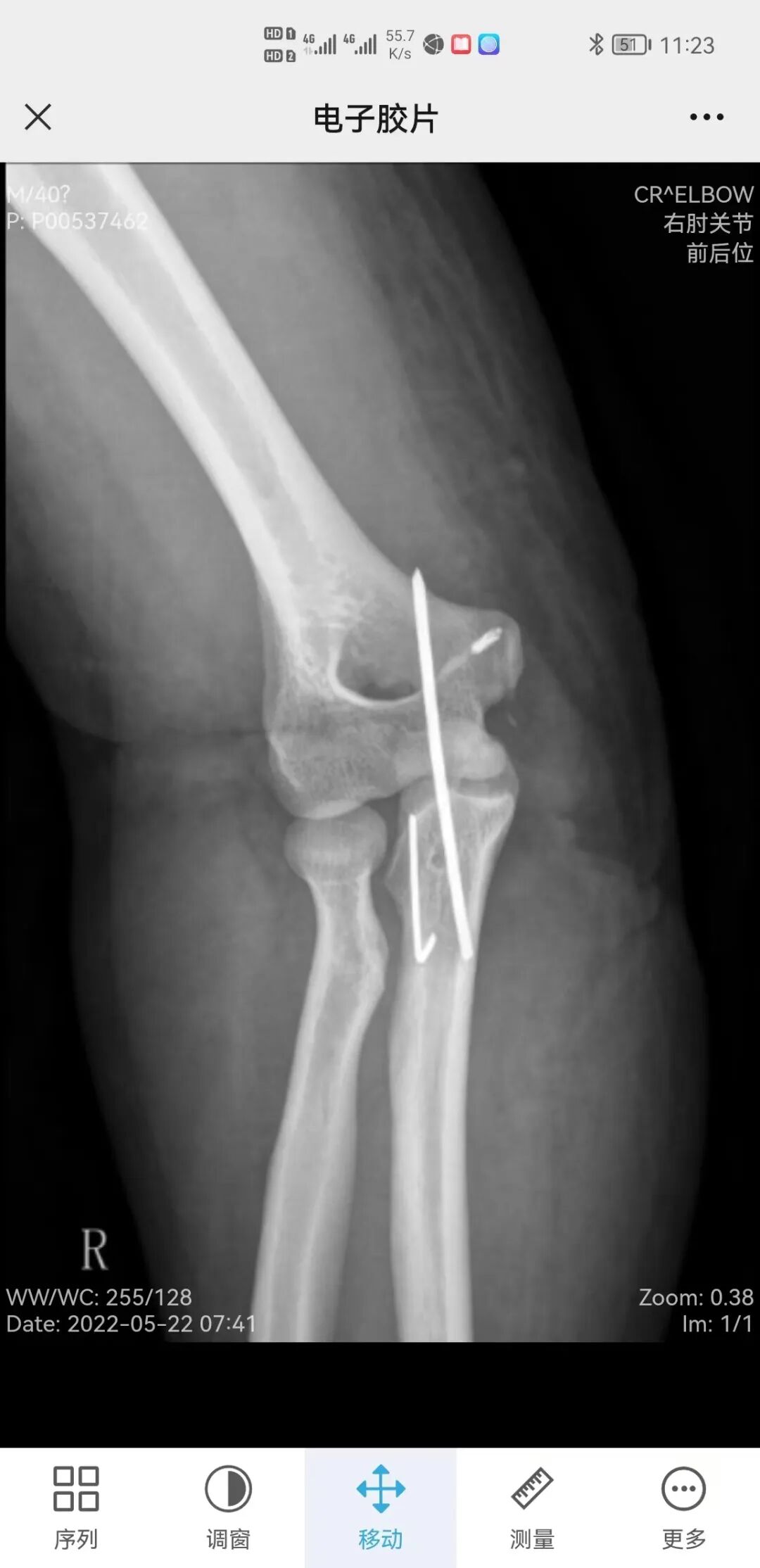 肘关节康复器怎么用“能屈能伸”——创伤后肘关节僵硬，这样治疗效果佳！_https://www.jmylbn.com_新闻资讯_第1张