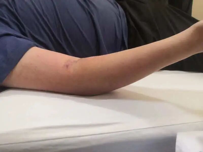 肘关节康复器怎么用“能屈能伸”——创伤后肘关节僵硬，这样治疗效果佳！_https://www.jmylbn.com_新闻资讯_第5张