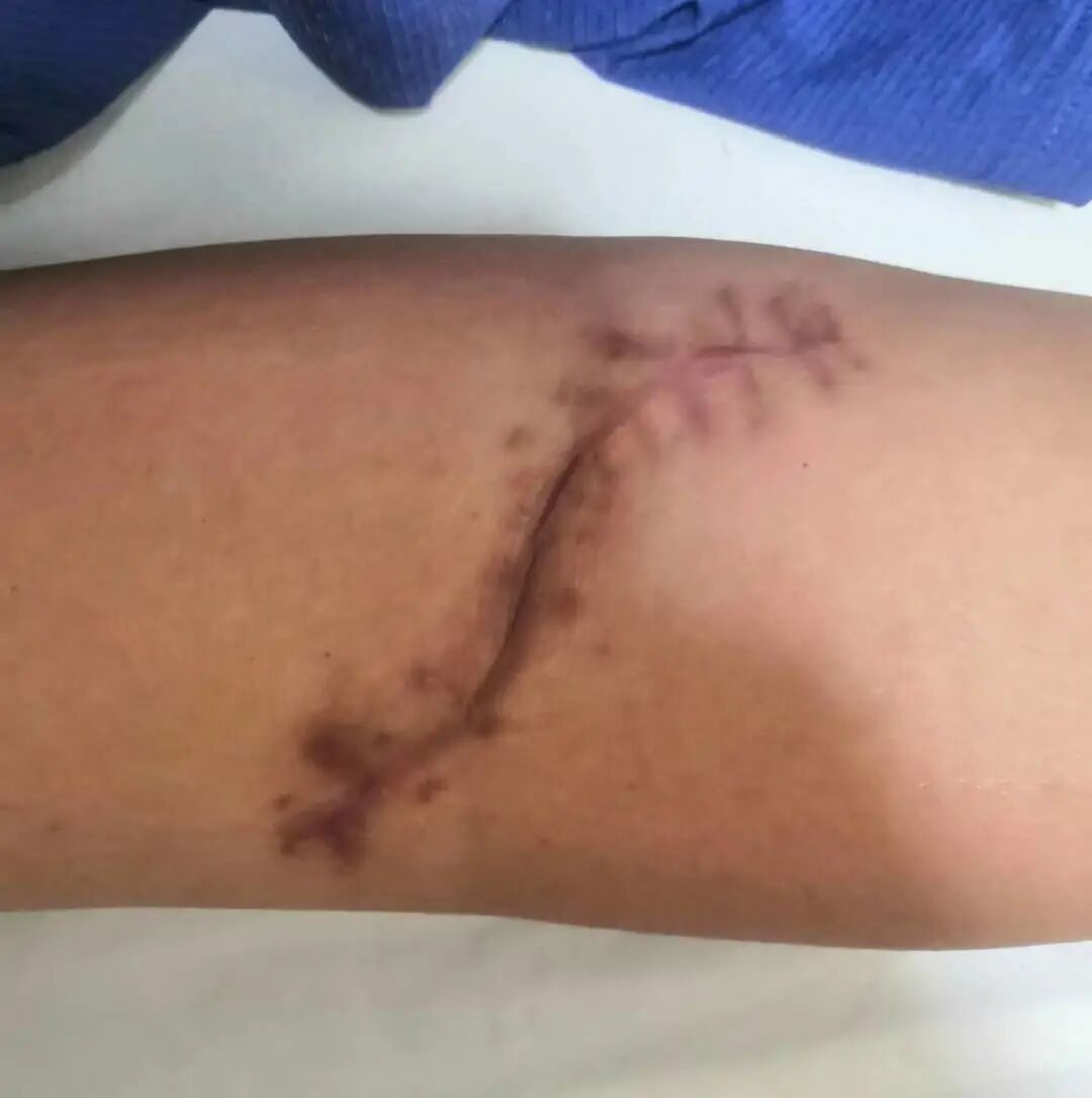 肘关节康复器怎么用“能屈能伸”——创伤后肘关节僵硬，这样治疗效果佳！_https://www.jmylbn.com_新闻资讯_第3张