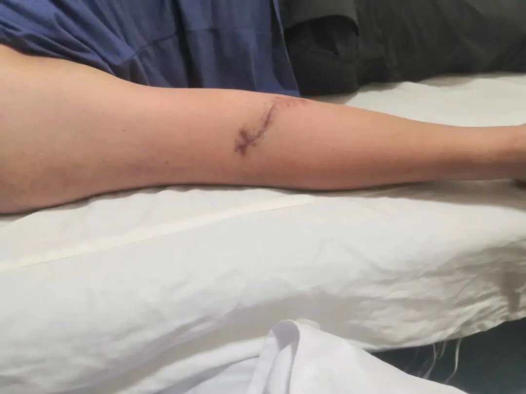 肘关节康复器怎么用“能屈能伸”——创伤后肘关节僵硬，这样治疗效果佳！_https://www.jmylbn.com_新闻资讯_第7张