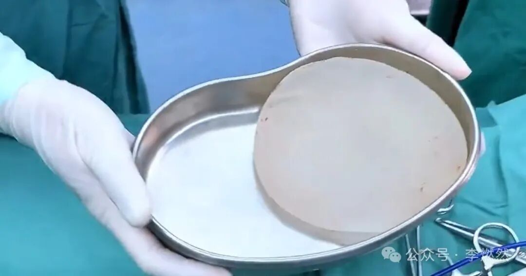 三甲医生揭秘：百万隆胸手术成本或仅五千，富婆豪掷背后的行业真相