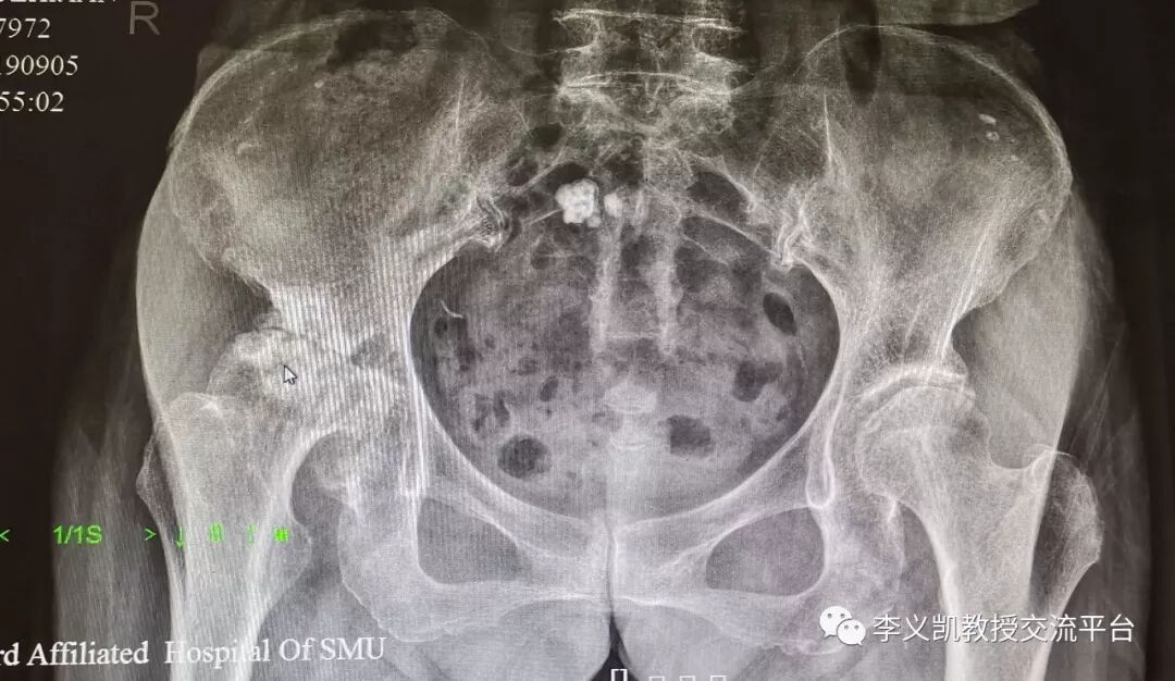 股骨头坏死和骨关节炎 李义凯教授交流平台 微信公众号文章阅读 Wemp