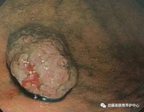 为何中老年人更容易患上胃息肉？癌变几率有多大？做到这几点，有效降低发病率