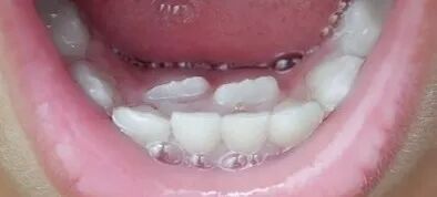 曲面断层片怎么看换牙与身高有关吗？关于孩子换牙的所有疑问一篇说清_https://www.jmylbn.com_新闻资讯_第16张