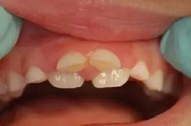 曲面断层片怎么看换牙与身高有关吗？关于孩子换牙的所有疑问一篇说清_https://www.jmylbn.com_新闻资讯_第17张