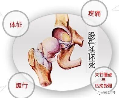 髋关节疼痛的原因有哪些，如何治疗？