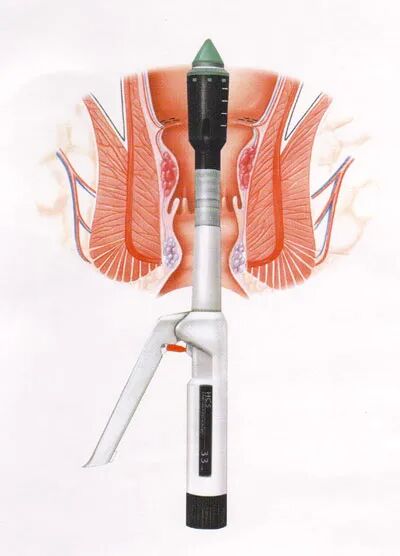 痔疮套扎吻合器是什么从传统经典″痔疗″到微创无痛彻底″根痔″【“菊长”来了③特色篇】_https://www.jmylbn.com_新闻资讯_第8张