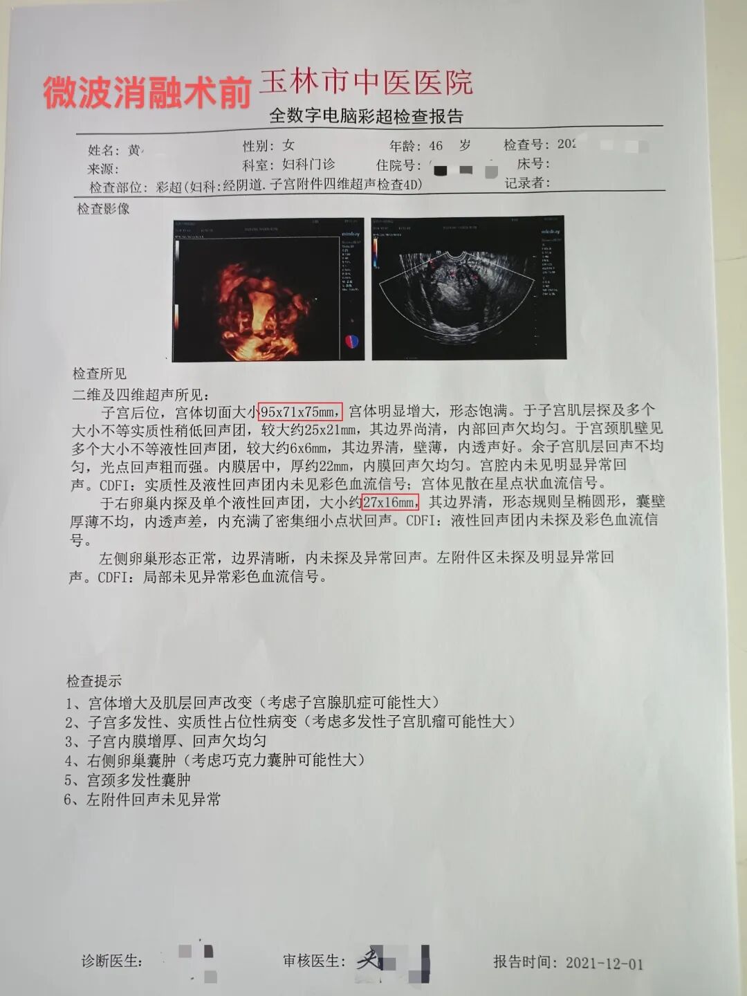 妇科微波怎么操作【新技术】关爱子宫，一根小小微波消融针让子宫腺肌病患者免受切除子宫!_https://www.jmylbn.com_新闻资讯_第4张