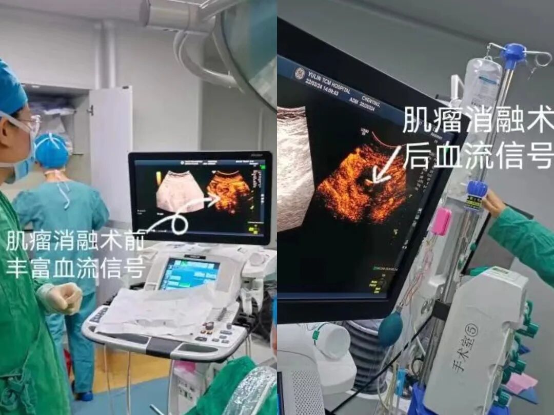 妇科微波怎么操作【新技术】关爱子宫，一根小小微波消融针让子宫腺肌病患者免受切除子宫!_https://www.jmylbn.com_新闻资讯_第3张