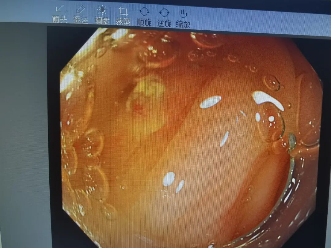 斑马导丝是治疗什么的【新技术】阑尾炎也可以不开刀：全市首例内镜逆行性阑尾炎治疗术（ERAT）+阑尾子镜+阑尾支架置入术_https://www.jmylbn.com_新闻资讯_第3张