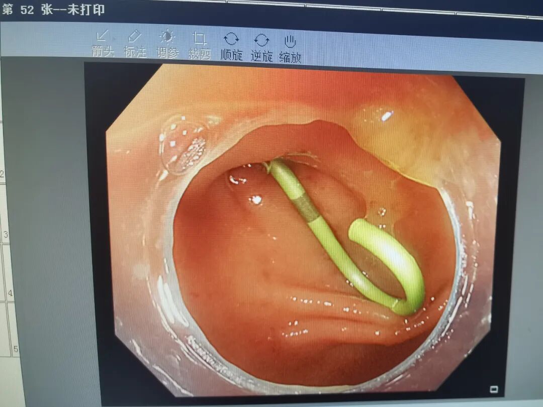 斑马导丝是治疗什么的【新技术】阑尾炎也可以不开刀：全市首例内镜逆行性阑尾炎治疗术（ERAT）+阑尾子镜+阑尾支架置入术_https://www.jmylbn.com_新闻资讯_第9张
