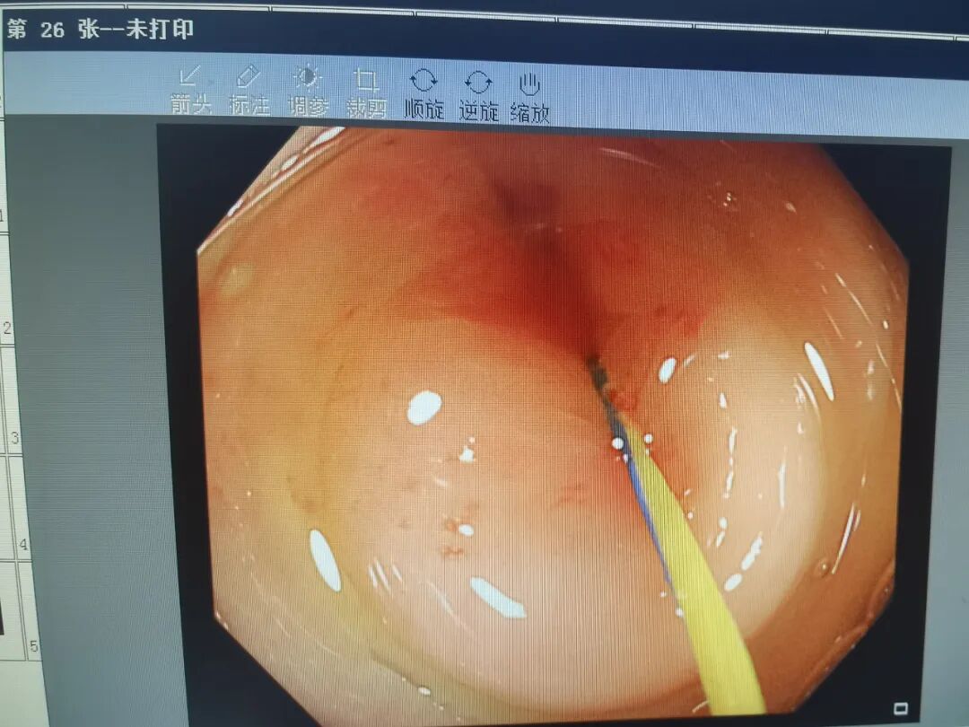 斑马导丝是治疗什么的【新技术】阑尾炎也可以不开刀：全市首例内镜逆行性阑尾炎治疗术（ERAT）+阑尾子镜+阑尾支架置入术_https://www.jmylbn.com_新闻资讯_第5张