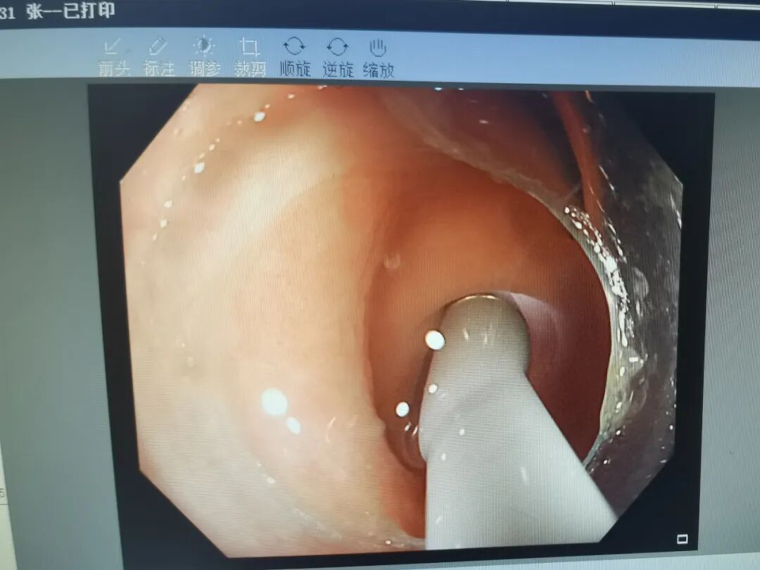 斑马导丝是治疗什么的【新技术】阑尾炎也可以不开刀：全市首例内镜逆行性阑尾炎治疗术（ERAT）+阑尾子镜+阑尾支架置入术_https://www.jmylbn.com_新闻资讯_第4张