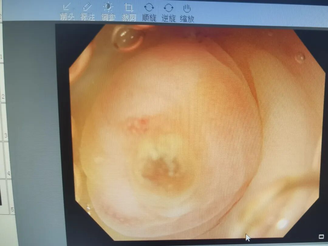 斑马导丝是治疗什么的【新技术】阑尾炎也可以不开刀：全市首例内镜逆行性阑尾炎治疗术（ERAT）+阑尾子镜+阑尾支架置入术_https://www.jmylbn.com_新闻资讯_第2张